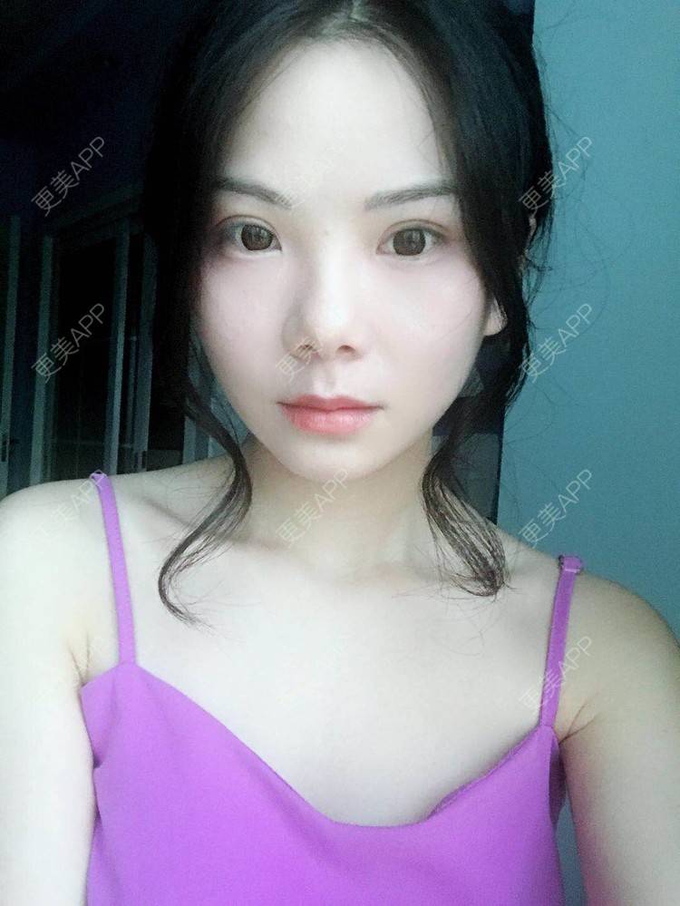更美 - 弥满遍地的桂花香的颧弓降低经验 | 颧骨颧弓 | 颧骨内推 | 颧骨提高 | 颧弓降低 | 颧骨填充