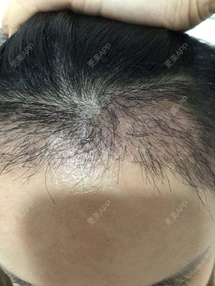 更美 - 奥多Ke。的植发际线经验 | 植发际线 | 南昌