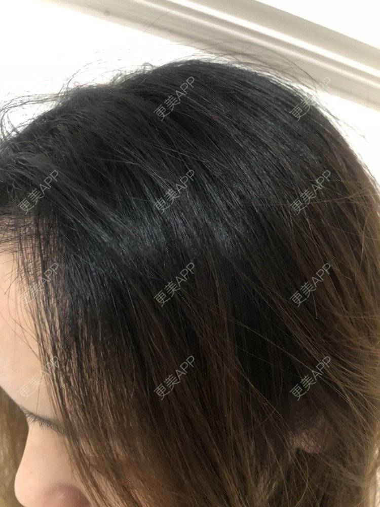 更美 - 奥多Ke。的植发际线经验 | 植发际线 | 南昌