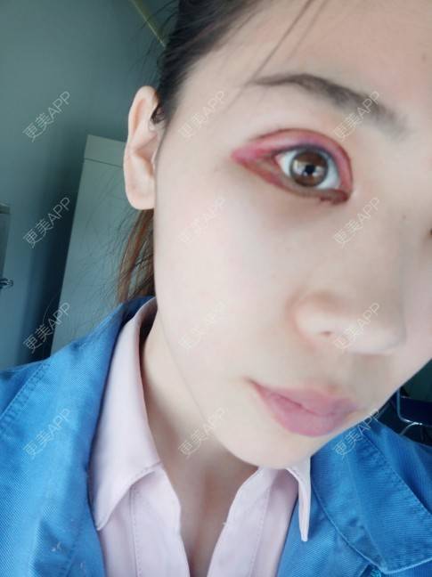 更美 - 更美用户YXs5bAlKu4的全切双眼皮经验 | 全切双眼皮 | 开内眼角 | 眼部多项