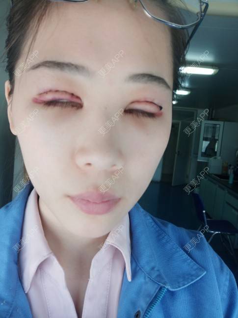 更美 - 更美用户YXs5bAlKu4的全切双眼皮经验 | 全切双眼皮 | 开内眼角 | 眼部多项