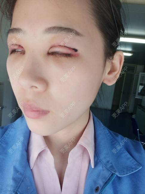 更美 - 更美用户YXs5bAlKu4的全切双眼皮经验 | 全切双眼皮 | 开内眼角 | 眼部多项