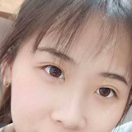 更美 - 更美用户YXs5bAlKu4的全切双眼皮经验 | 全切双眼皮 | 开内眼角 | 眼部多项