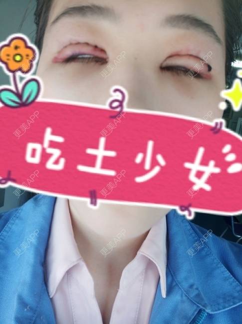 更美 - 更美用户YXs5bAlKu4的全切双眼皮经验 | 全切双眼皮 | 开内眼角 | 眼部多项