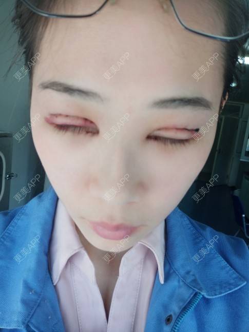 更美 - 更美用户YXs5bAlKu4的全切双眼皮经验 | 全切双眼皮 | 开内眼角 | 眼部多项