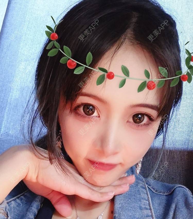 更美 - 大甜甜甜圈的肋软骨隆鼻经验 | 手术缩鼻头 | 上海 | 鼻形矫正 | 肋软骨隆鼻
