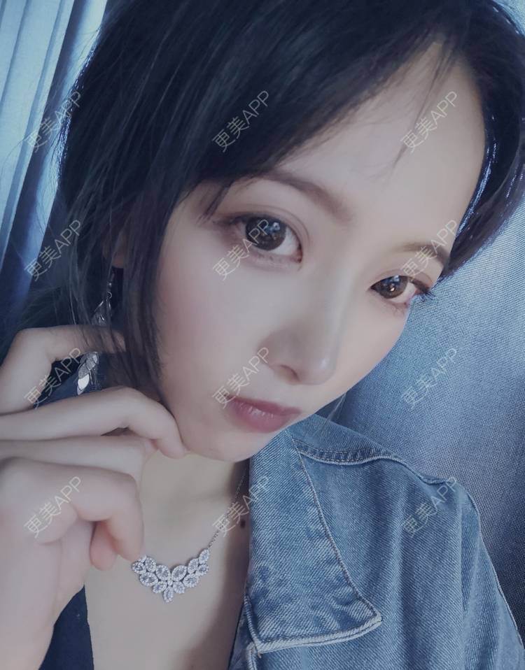 更美 - 大甜甜甜圈的肋软骨隆鼻经验 | 手术缩鼻头 | 上海 | 鼻形矫正 | 肋软骨隆鼻