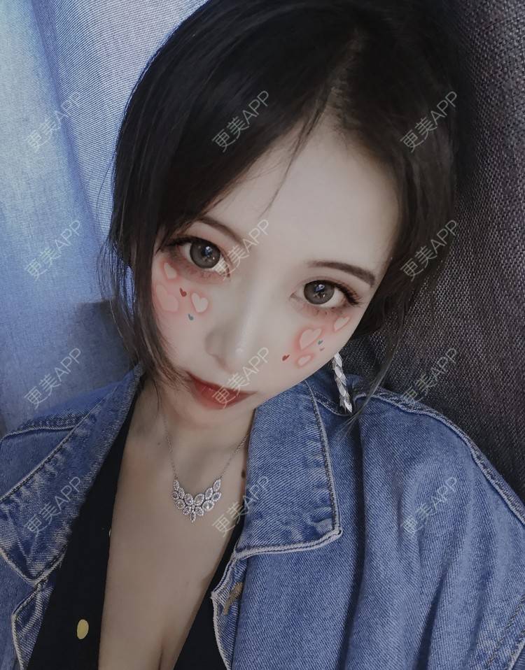 更美 - 大甜甜甜圈的肋软骨隆鼻经验 | 手术缩鼻头 | 上海 | 鼻形矫正 | 肋软骨隆鼻