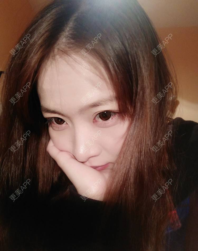 更美 - 大甜甜甜圈的肋软骨隆鼻经验 | 手术缩鼻头 | 上海 | 肋软骨隆鼻 | 鼻部综合