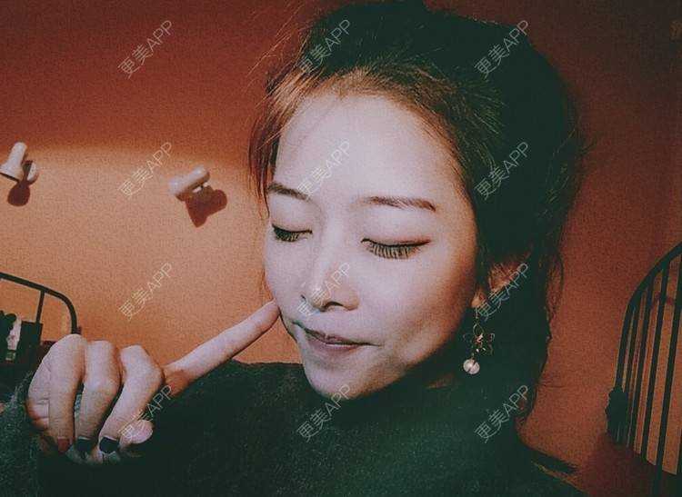 更美 - 大甜甜甜圈的肋软骨隆鼻经验 | 手术缩鼻头 | 上海 | 肋软骨隆鼻 | 鼻部综合