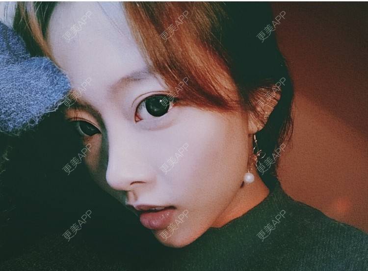 更美 - 大甜甜甜圈的肋软骨隆鼻经验 | 手术缩鼻头 | 上海 | 肋软骨隆鼻 | 鼻部综合