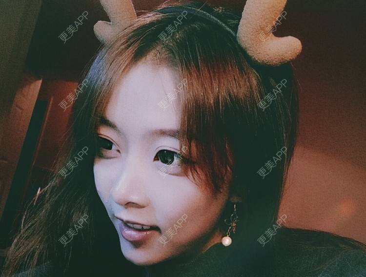 更美 - 大甜甜甜圈的肋软骨隆鼻经验 | 手术缩鼻头 | 上海 | 肋软骨隆鼻 | 鼻部综合