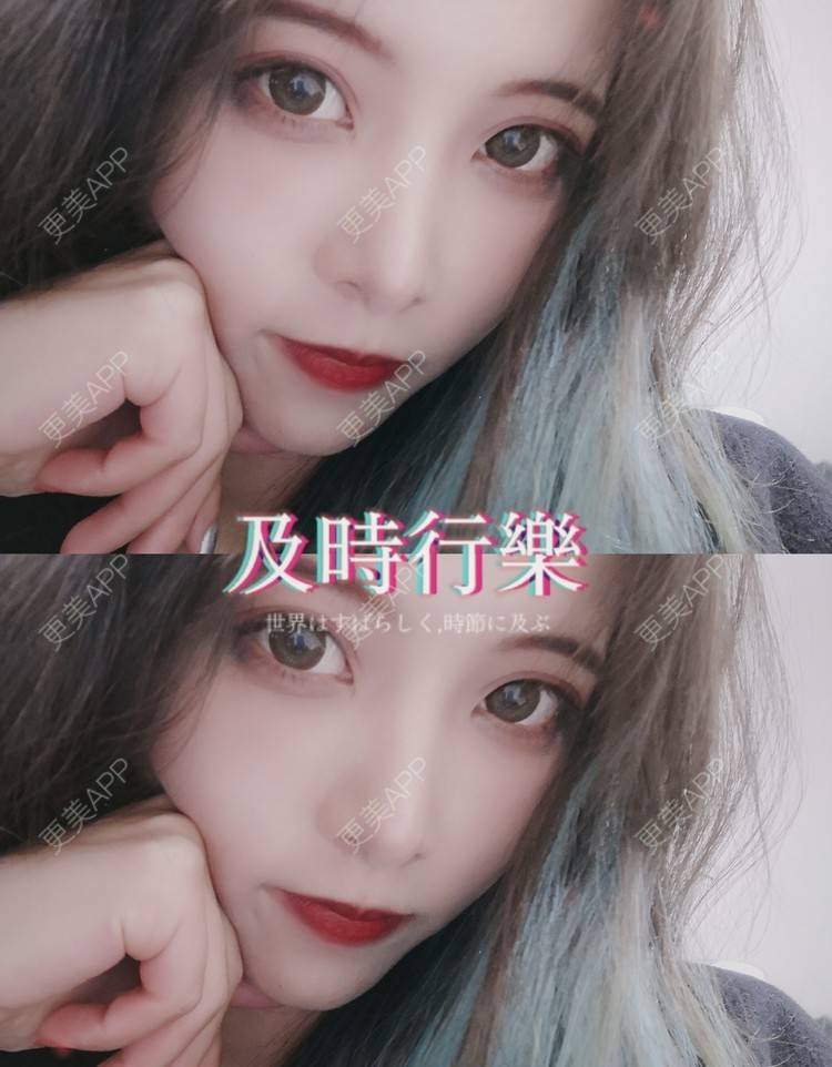 更美 - 大甜甜甜圈的肋软骨隆鼻经验 | 手术缩鼻头 | 肋软骨隆鼻 | 鼻部综合 | 上海