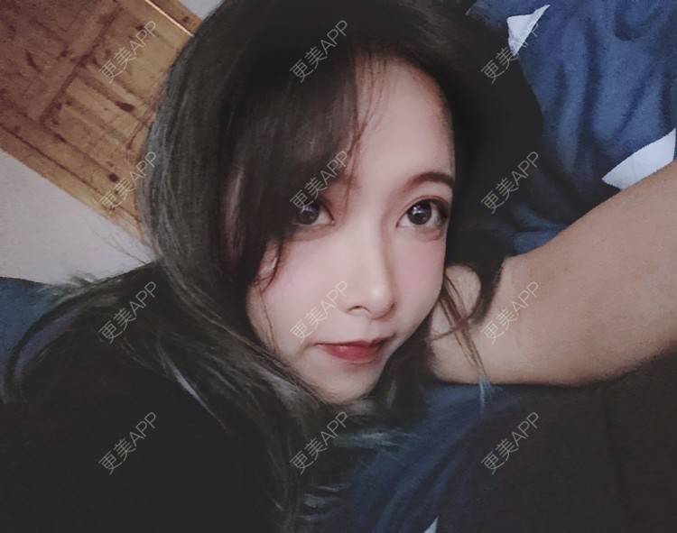 更美 - 大甜甜甜圈的肋软骨隆鼻经验 | 手术缩鼻头 | 肋软骨隆鼻 | 鼻部综合 | 上海