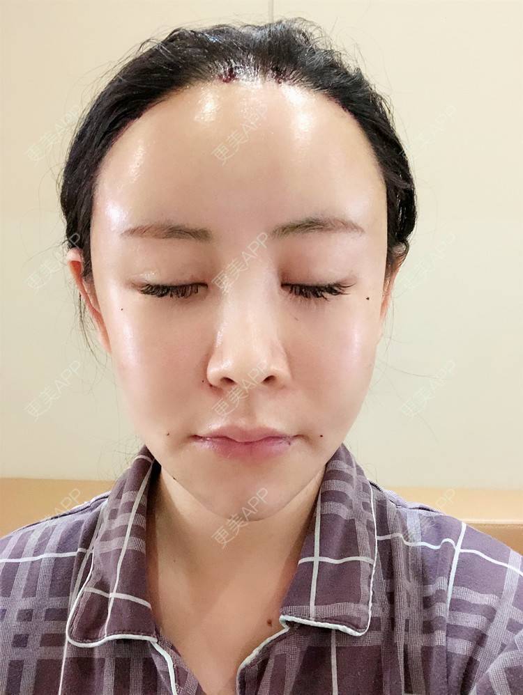 更美 - 兰质慧心的自体脂肪丰苹果肌经验 | 自体脂肪丰苹果肌 | 上海 | 自体脂肪丰面颊 | 自体脂肪垫下巴 | 视频日记