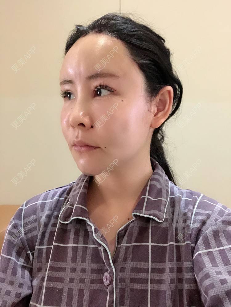 更美 - 兰质慧心的自体脂肪丰苹果肌经验 | 自体脂肪丰苹果肌 | 上海 | 自体脂肪丰面颊 | 自体脂肪垫下巴 | 视频日记