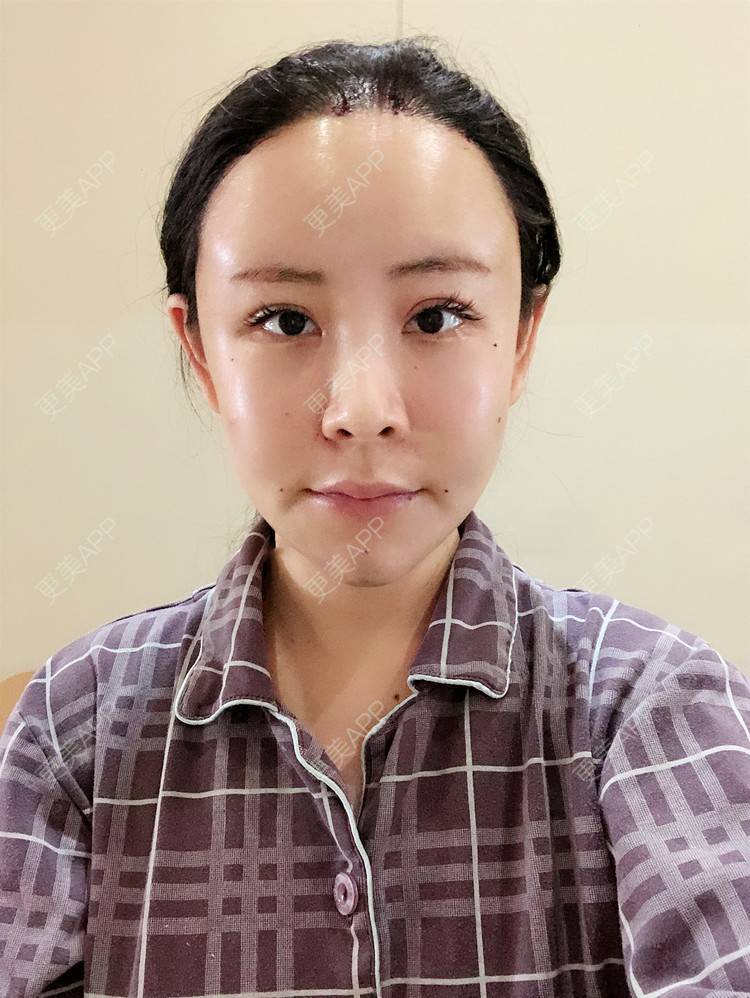 更美 - 兰质慧心的自体脂肪丰苹果肌经验 | 自体脂肪丰苹果肌 | 上海 | 自体脂肪丰面颊 | 自体脂肪垫下巴 | 视频日记