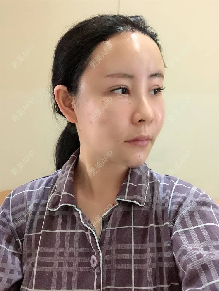 更美 - 兰质慧心的自体脂肪丰苹果肌经验 | 自体脂肪丰苹果肌 | 上海 | 自体脂肪丰面颊 | 自体脂肪垫下巴 | 视频日记