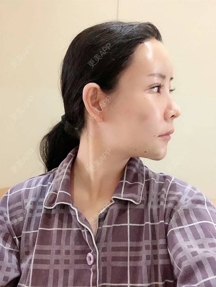 更美 - 兰质慧心的自体脂肪丰苹果肌经验 | 自体脂肪丰苹果肌 | 上海 | 自体脂肪丰面颊 | 自体脂肪垫下巴 | 视频日记