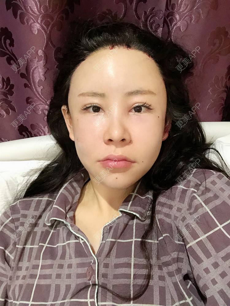 更美 - 兰质慧心的自体脂肪丰苹果肌经验 | 自体脂肪丰苹果肌 | 上海 | 自体脂肪丰面颊 | 自体脂肪垫下巴 | 视频日记