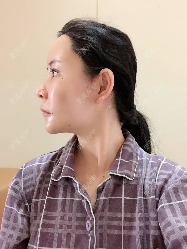 更美 - 兰质慧心的自体脂肪丰苹果肌经验 | 自体脂肪丰苹果肌 | 上海 | 自体脂肪丰面颊 | 自体脂肪垫下巴 | 视频日记