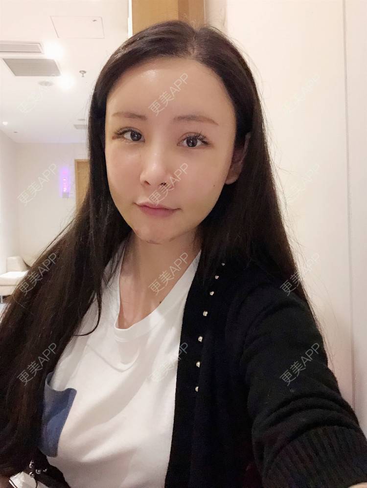 更美 - 兰质慧心的自体脂肪丰苹果肌经验 | 自体脂肪丰苹果肌 | 上海 | 自体脂肪垫下巴 | 自体脂肪丰面颊 | 视频日记