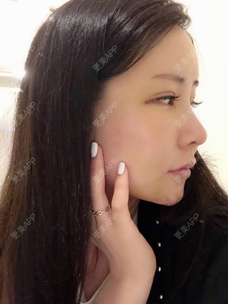 更美 - 兰质慧心的自体脂肪丰苹果肌经验 | 自体脂肪丰苹果肌 | 上海 | 自体脂肪垫下巴 | 自体脂肪丰面颊 | 视频日记