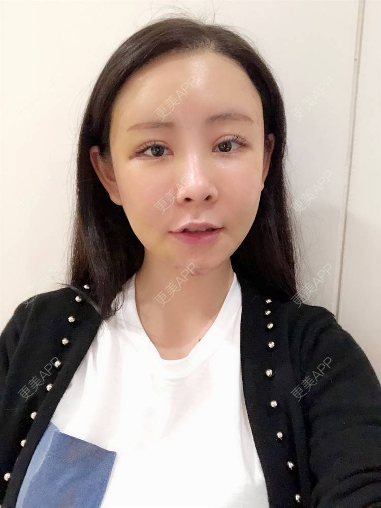 更美 - 兰质慧心的自体脂肪丰苹果肌经验 | 自体脂肪丰苹果肌 | 上海 | 自体脂肪垫下巴 | 自体脂肪丰面颊 | 视频日记
