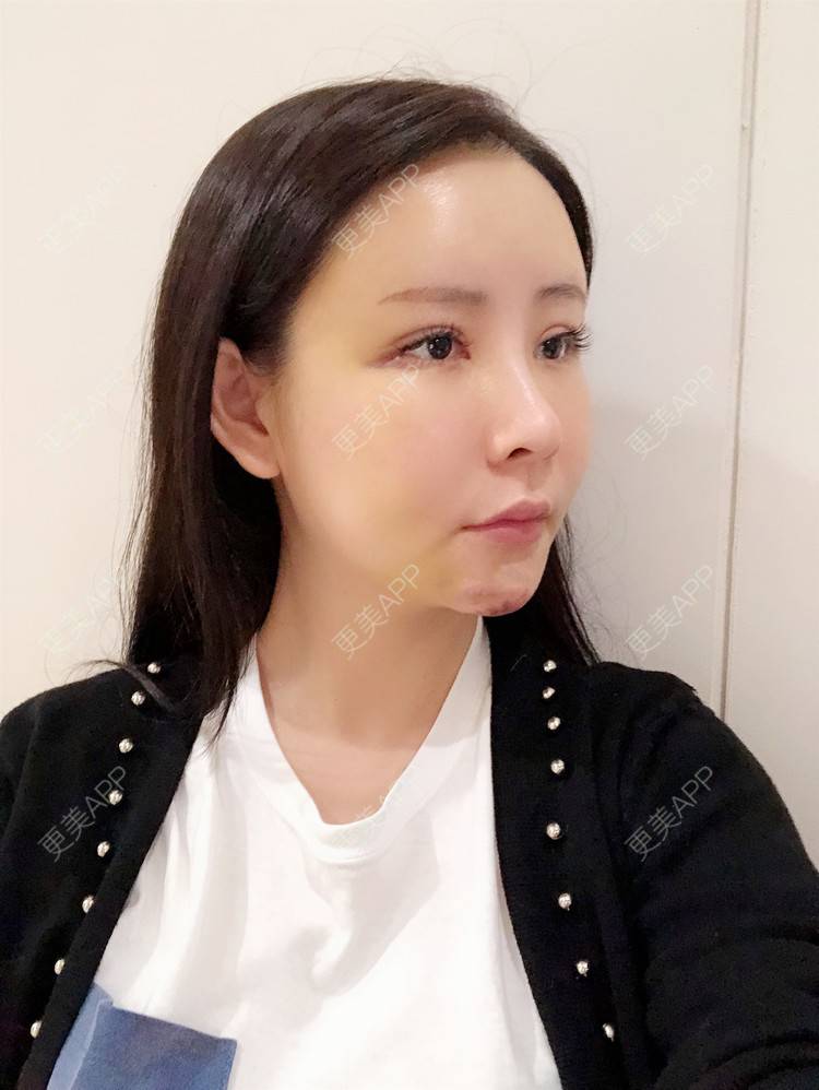 更美 - 兰质慧心的自体脂肪丰苹果肌经验 | 自体脂肪丰苹果肌 | 上海 | 自体脂肪垫下巴 | 自体脂肪丰面颊 | 视频日记