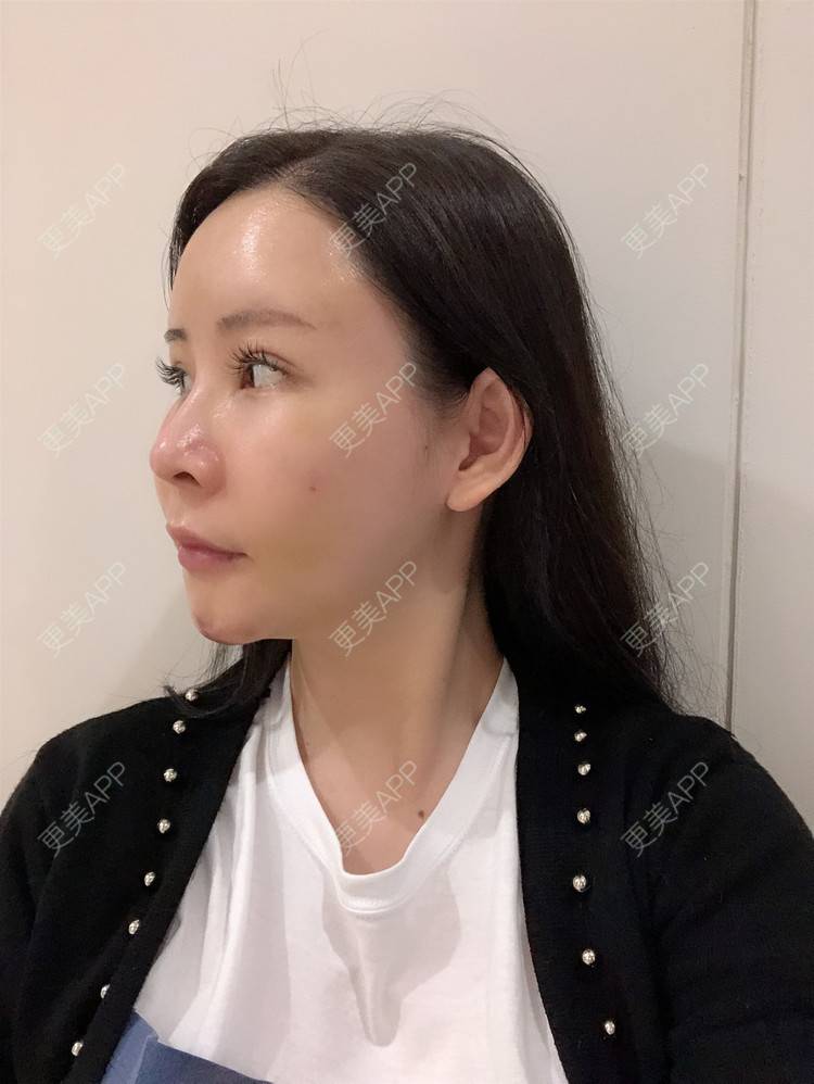 更美 - 兰质慧心的自体脂肪丰苹果肌经验 | 自体脂肪丰苹果肌 | 上海 | 自体脂肪垫下巴 | 自体脂肪丰面颊 | 视频日记