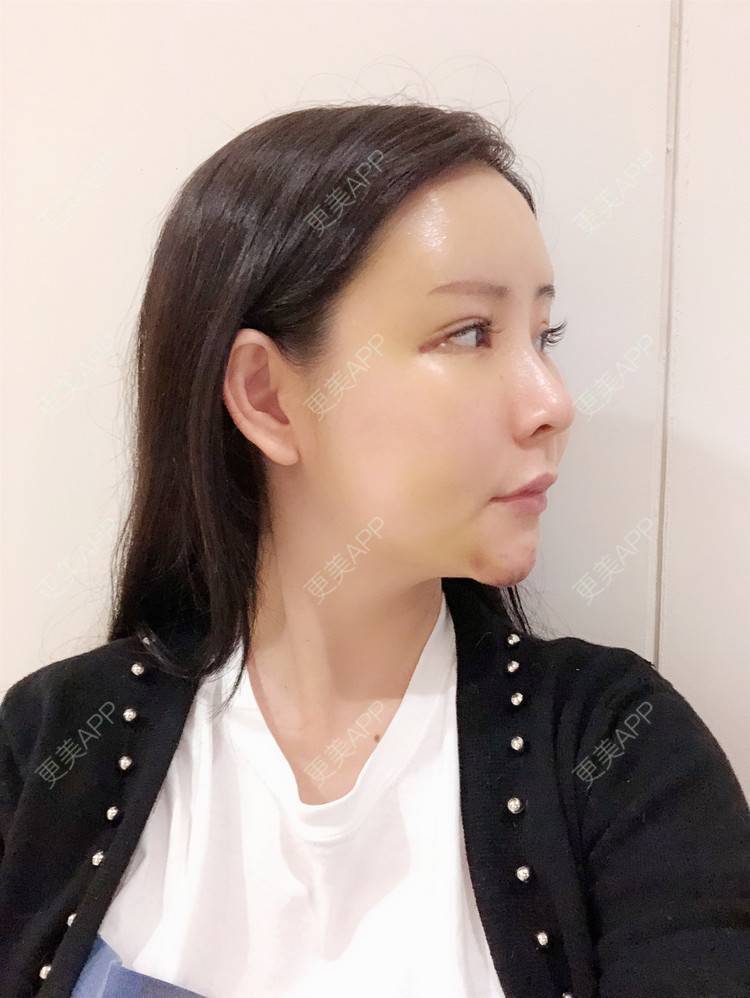 更美 - 兰质慧心的自体脂肪丰苹果肌经验 | 自体脂肪丰苹果肌 | 上海 | 自体脂肪垫下巴 | 自体脂肪丰面颊 | 视频日记