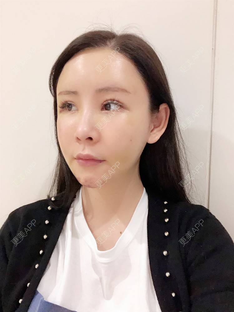 更美 - 兰质慧心的自体脂肪丰苹果肌经验 | 自体脂肪丰苹果肌 | 上海 | 自体脂肪垫下巴 | 自体脂肪丰面颊 | 视频日记