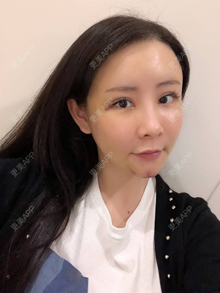 更美 - 兰质慧心的自体脂肪丰苹果肌经验 | 自体脂肪丰苹果肌 | 上海 | 自体脂肪垫下巴 | 自体脂肪丰面颊 | 视频日记