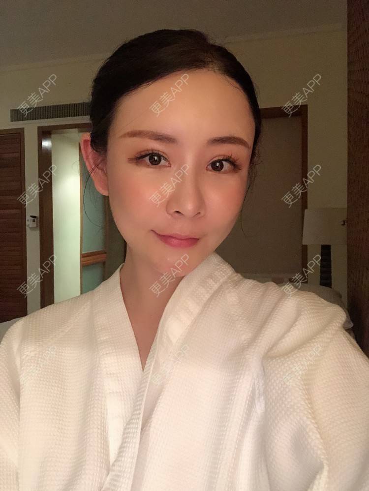 更美 - 兰质慧心的自体脂肪丰苹果肌经验 | 上海 | 视频日记 | 自体脂肪丰面颊 | 自体脂肪丰苹果肌 | 自体脂肪垫下巴