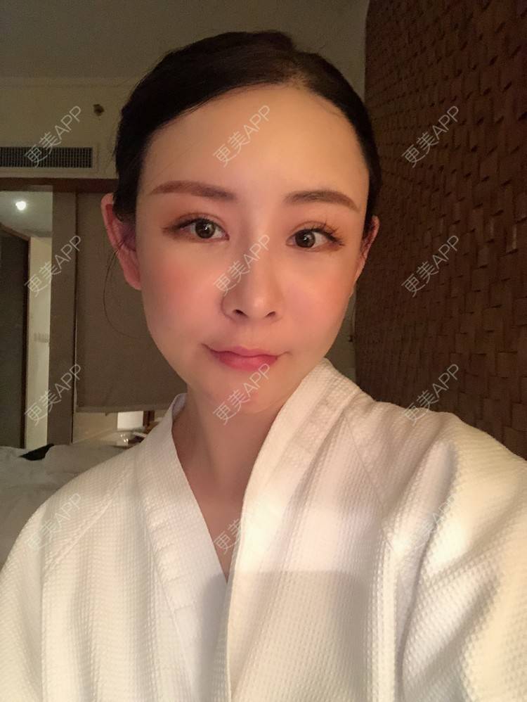更美 - 兰质慧心的自体脂肪丰苹果肌经验 | 上海 | 视频日记 | 自体脂肪丰面颊 | 自体脂肪丰苹果肌 | 自体脂肪垫下巴