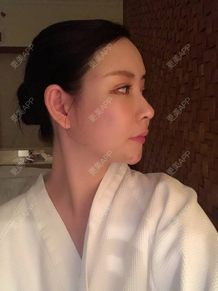 更美 - 兰质慧心的自体脂肪丰苹果肌经验 | 上海 | 视频日记 | 自体脂肪丰面颊 | 自体脂肪丰苹果肌 | 自体脂肪垫下巴