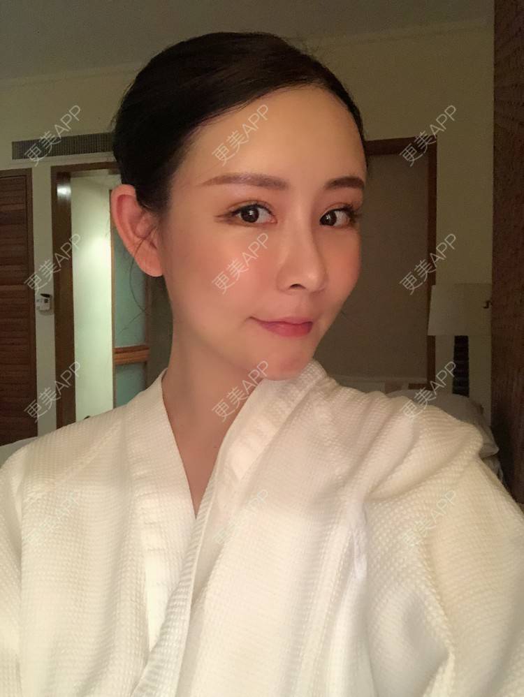 更美 - 兰质慧心的自体脂肪丰苹果肌经验 | 上海 | 视频日记 | 自体脂肪丰面颊 | 自体脂肪丰苹果肌 | 自体脂肪垫下巴