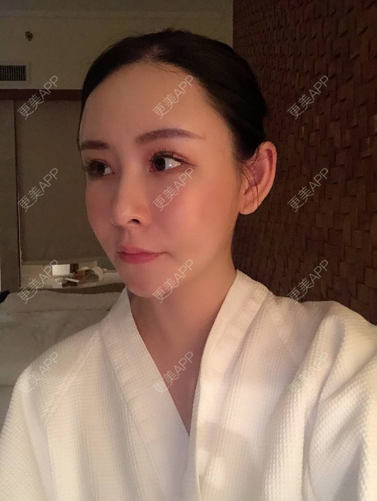 更美 - 兰质慧心的自体脂肪丰苹果肌经验 | 上海 | 视频日记 | 自体脂肪丰面颊 | 自体脂肪丰苹果肌 | 自体脂肪垫下巴