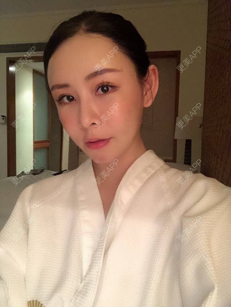 更美 - 兰质慧心的自体脂肪丰苹果肌经验 | 上海 | 视频日记 | 自体脂肪丰面颊 | 自体脂肪丰苹果肌 | 自体脂肪垫下巴