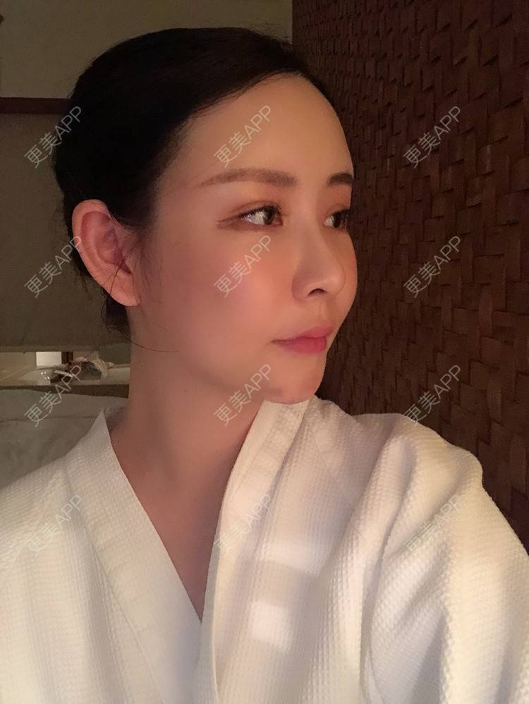 更美 - 兰质慧心的自体脂肪丰苹果肌经验 | 上海 | 视频日记 | 自体脂肪丰面颊 | 自体脂肪丰苹果肌 | 自体脂肪垫下巴