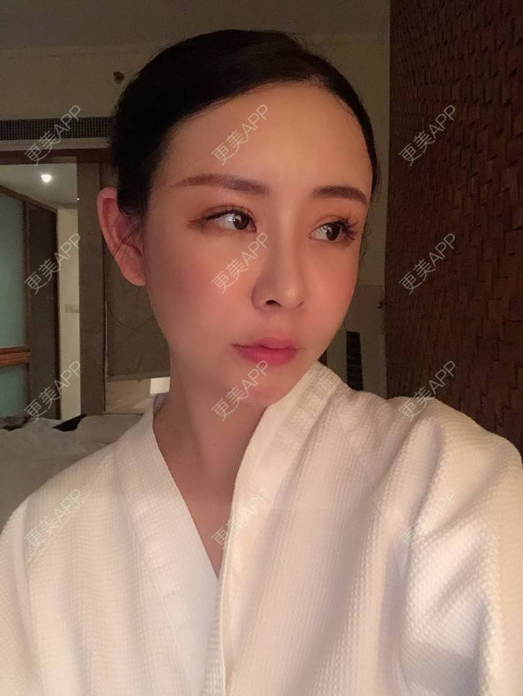 更美 - 兰质慧心的自体脂肪丰苹果肌经验 | 上海 | 视频日记 | 自体脂肪丰面颊 | 自体脂肪丰苹果肌 | 自体脂肪垫下巴