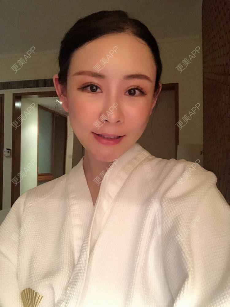更美 - 兰质慧心的自体脂肪丰苹果肌经验 | 上海 | 视频日记 | 自体脂肪丰面颊 | 自体脂肪丰苹果肌 | 自体脂肪垫下巴