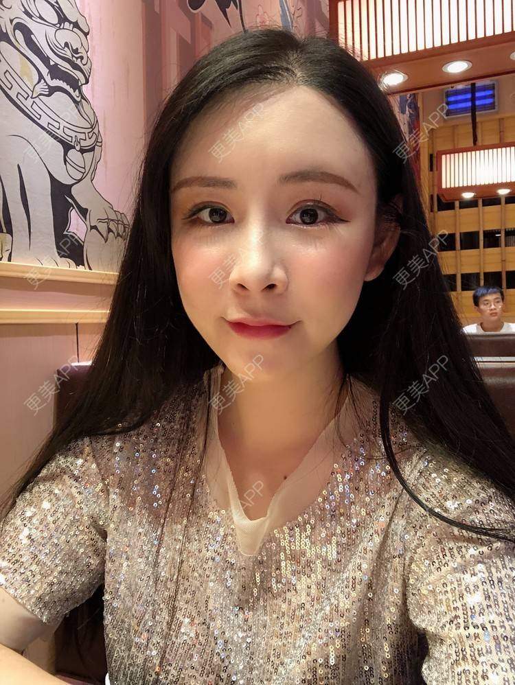 更美 - 兰质慧心的自体脂肪丰苹果肌经验 | 上海 | 视频日记 | 自体脂肪丰面颊 | 自体脂肪丰苹果肌 | 自体脂肪垫下巴