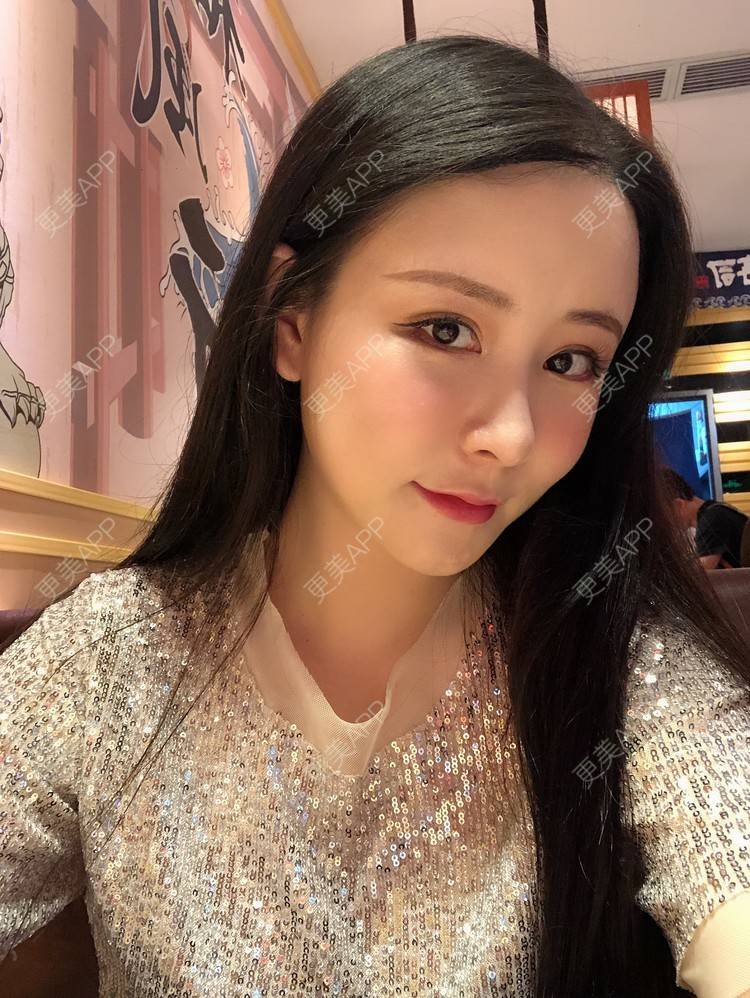 更美 - 兰质慧心的自体脂肪丰苹果肌经验 | 上海 | 视频日记 | 自体脂肪丰面颊 | 自体脂肪丰苹果肌 | 自体脂肪垫下巴