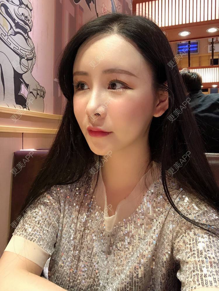 更美 - 兰质慧心的自体脂肪丰苹果肌经验 | 上海 | 视频日记 | 自体脂肪丰面颊 | 自体脂肪丰苹果肌 | 自体脂肪垫下巴
