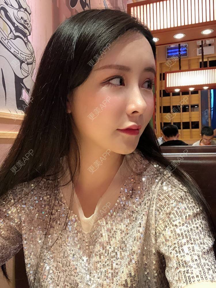 更美 - 兰质慧心的自体脂肪丰苹果肌经验 | 上海 | 视频日记 | 自体脂肪丰面颊 | 自体脂肪丰苹果肌 | 自体脂肪垫下巴