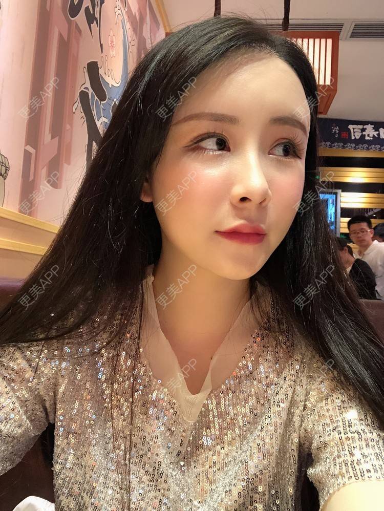 更美 - 兰质慧心的自体脂肪丰苹果肌经验 | 上海 | 视频日记 | 自体脂肪丰面颊 | 自体脂肪丰苹果肌 | 自体脂肪垫下巴