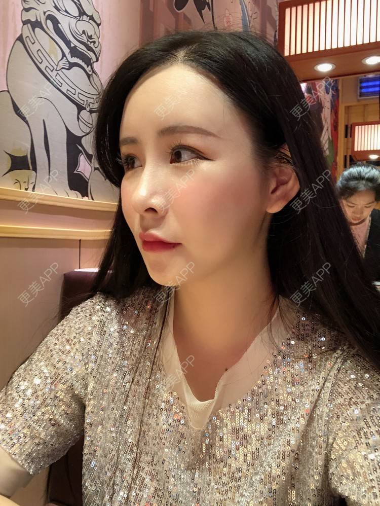 更美 - 兰质慧心的自体脂肪丰苹果肌经验 | 上海 | 视频日记 | 自体脂肪丰面颊 | 自体脂肪丰苹果肌 | 自体脂肪垫下巴