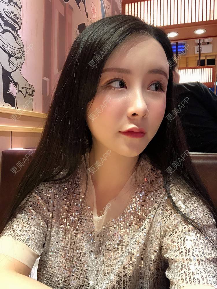 更美 - 兰质慧心的自体脂肪丰苹果肌经验 | 上海 | 视频日记 | 自体脂肪丰面颊 | 自体脂肪丰苹果肌 | 自体脂肪垫下巴