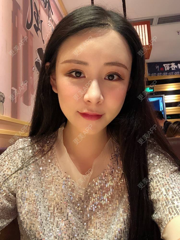 更美 - 兰质慧心的自体脂肪丰苹果肌经验 | 上海 | 视频日记 | 自体脂肪丰面颊 | 自体脂肪丰苹果肌 | 自体脂肪垫下巴